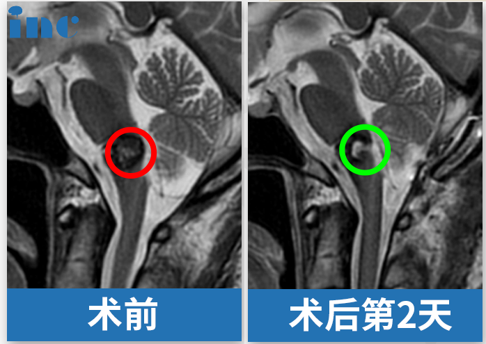 手术结果：显微镜下全切肿瘤，手术顺利。术后无任何新发神经损伤