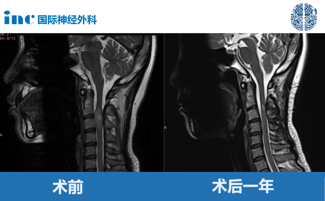 高位脊髓肿瘤真实案例