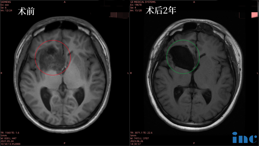 16岁男孩--右侧额叶、岛叶胶质瘤