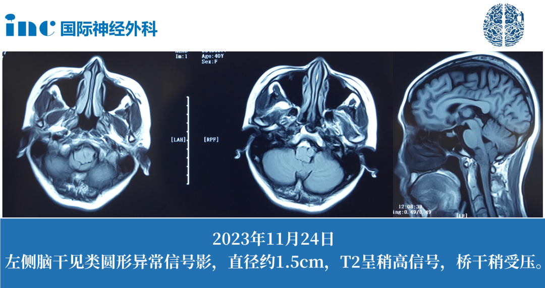 40岁女性--延髓占位性病变