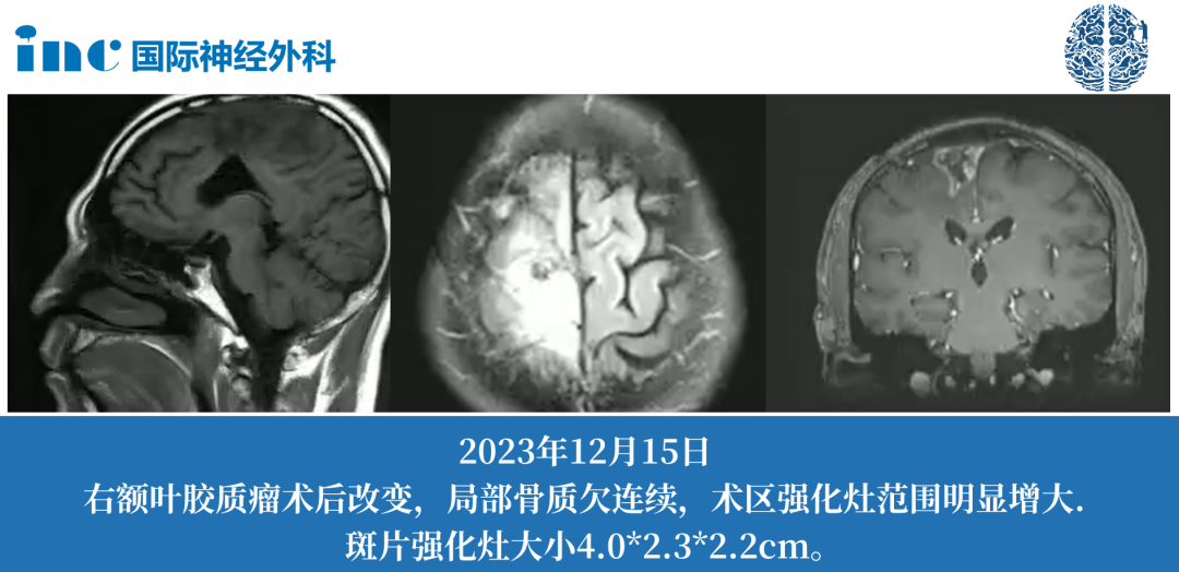 46岁--胶质母细胞瘤4级