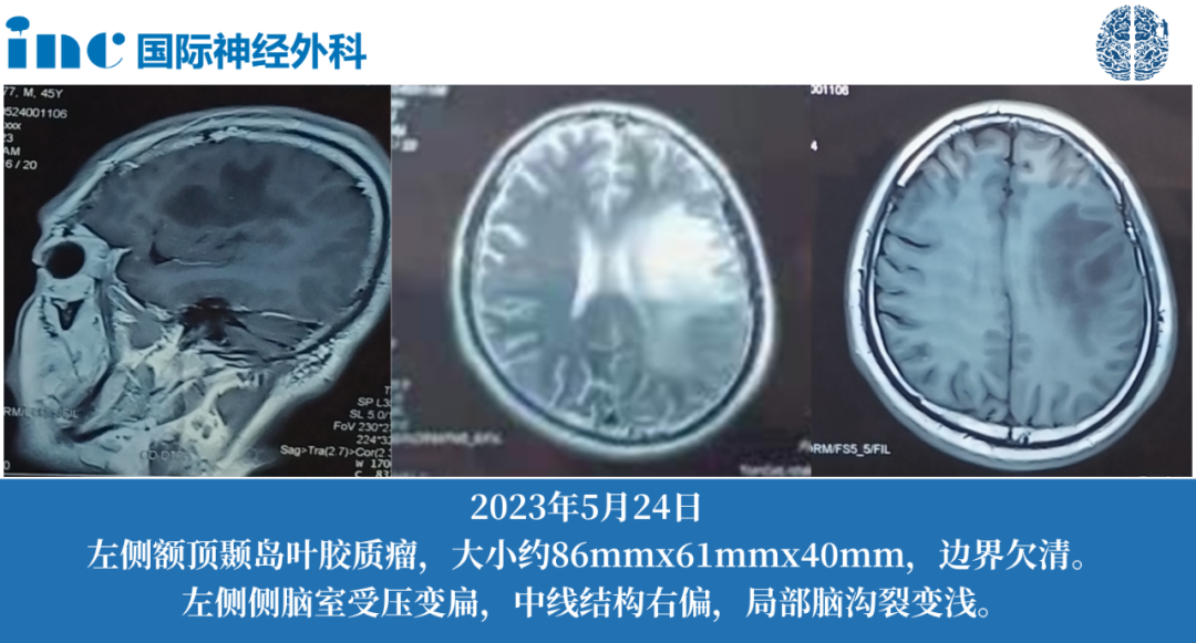 48岁男性--左侧额顶颞岛叶胶质瘤