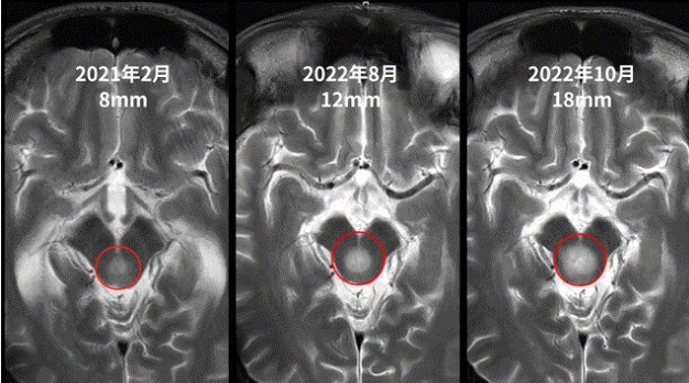 21岁男性--中脑顶盖胶质瘤