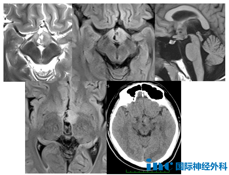 15岁男孩--视神经胶质瘤