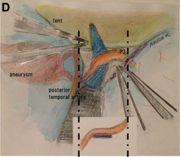 P3段被选为搭桥血管位置（图2C和2D）。如上所述，教授进行了STA-P3旁路手术并孤立动脉瘤。为了夹住动脉瘤，Kawashima教授使用了直长夹和有孔夹的组合，以避免P3段和PTA扭结。