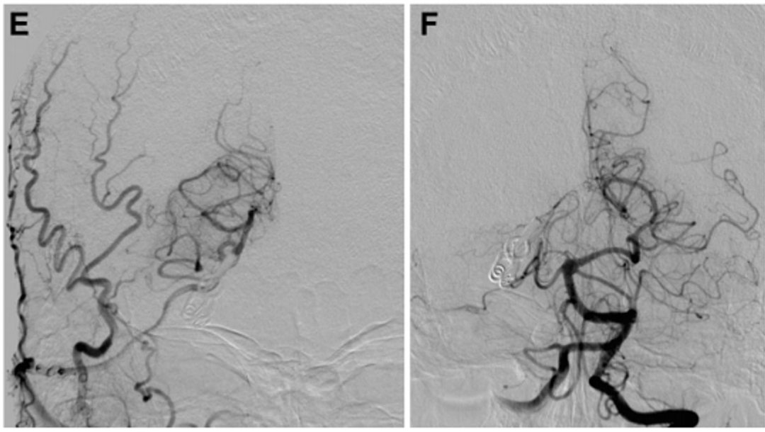 此后，通过吲哚菁绿荧光血管造影证实旁路、P3段和PTA的通畅。Kawashima教授打开动脉瘤以确保其完全闭塞并继续进行血栓切除术。患者出院时没有出现任何神经功能缺损，并且在1年随访时，旁路仍然通畅，并成功通过手术孤立了动脉瘤（图2E和2F）。