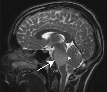 图1：T2加权矢状面（DIPG）儿童脑部MRI