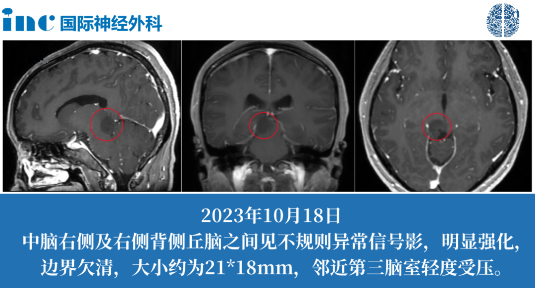 低级别胶质瘤