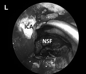 (L)使用鼻中隔瓣(NSF)完成封闭。CC，囊包膜；PFD，后颅窝硬脑膜；S，蝶鞍；T，肿瘤。