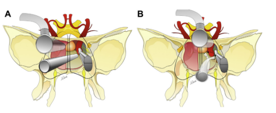 (A)Binostril和(B)使用有角度器械的单鼻孔入路。旋转轴与吸力角度相结合，导致手指的小动作在曝光深度上被放大，并允许360度范围。当用拇指和中指和无名指控制时，吸力还可以沿前后方向移动。