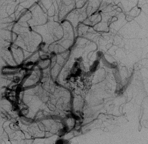 该AVM由ACA/PcaA分支、ACoA穿支和mPChA供血[右侧ICA造影