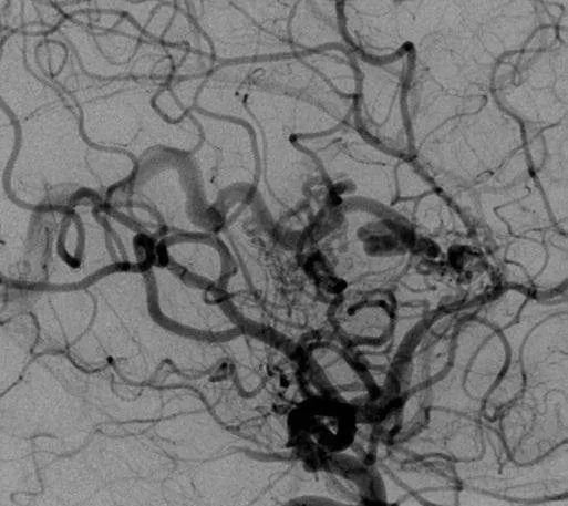 该AVM由ACA/PcaA分支、ACoA穿支和mPChA供血[右侧ICA造影