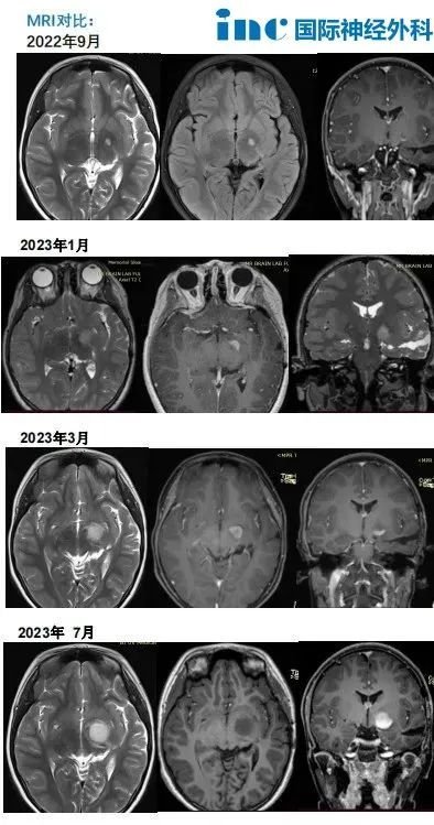11岁女孩Judy-左侧丘脑和颞叶内侧胶质瘤术后复发