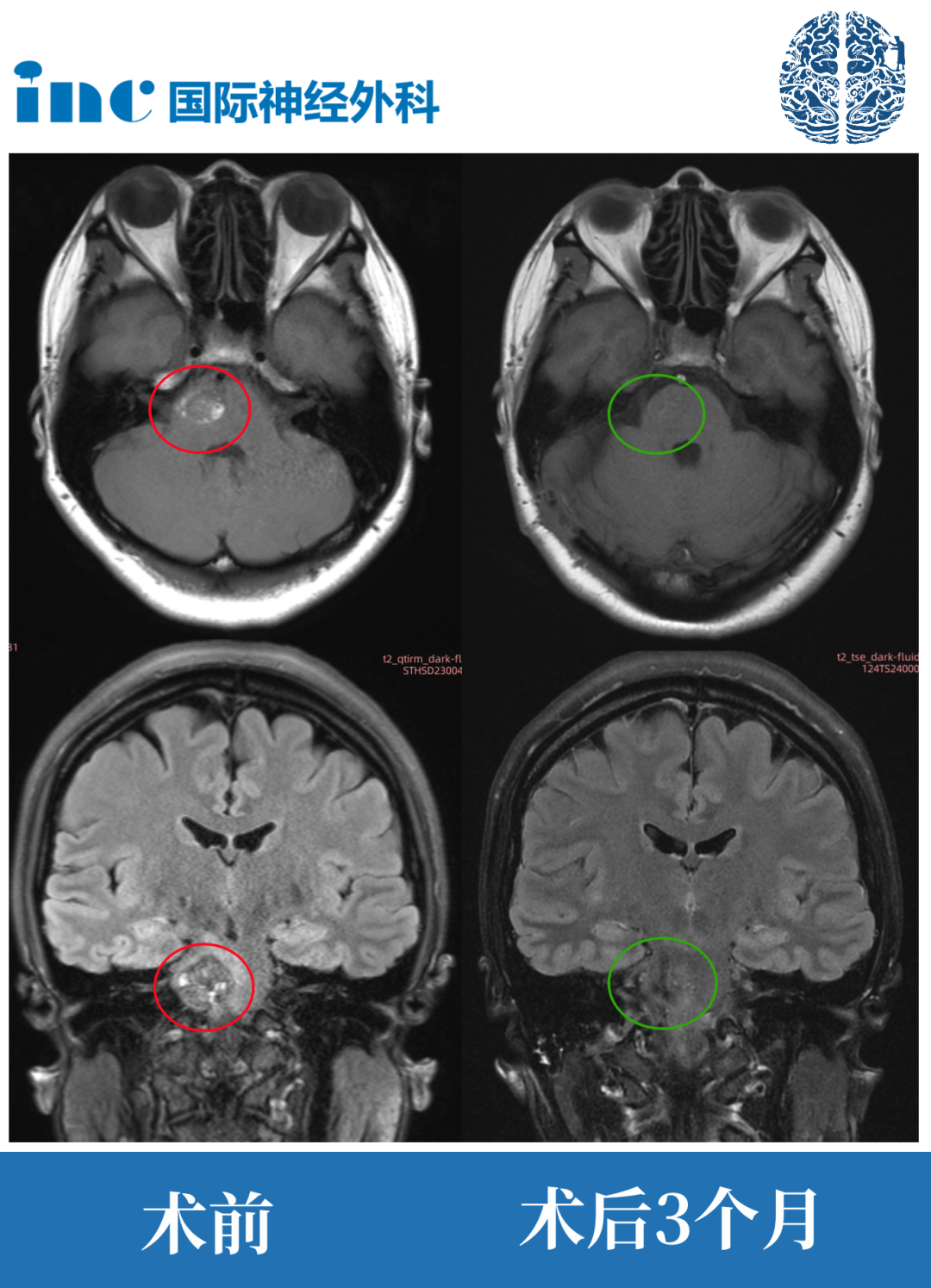 脑干海绵状血管瘤案例影像