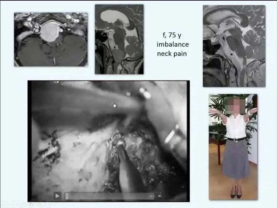 INC巴教授枕骨大孔区脑膜瘤精彩案例