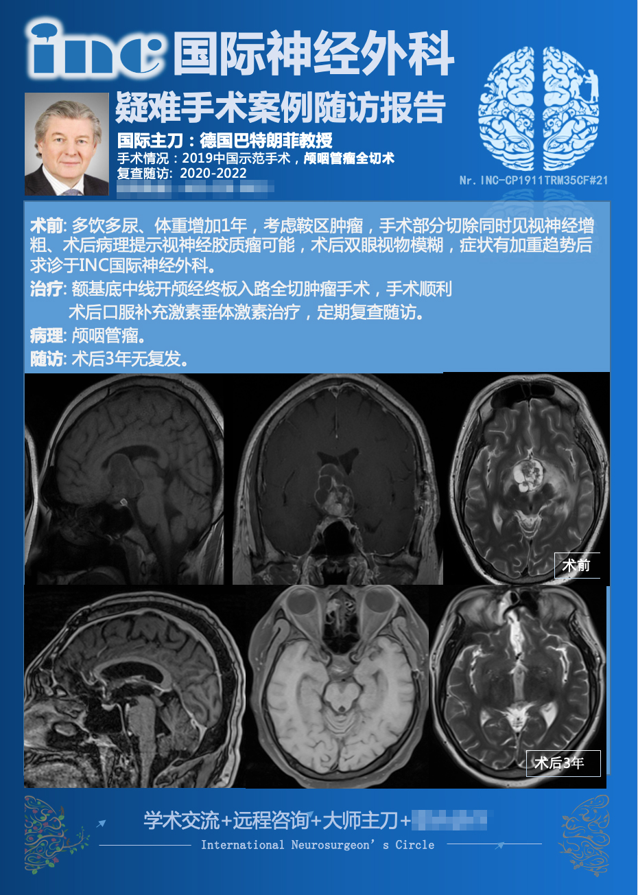 30多岁男性颅咽管瘤全切术后3年没有复发