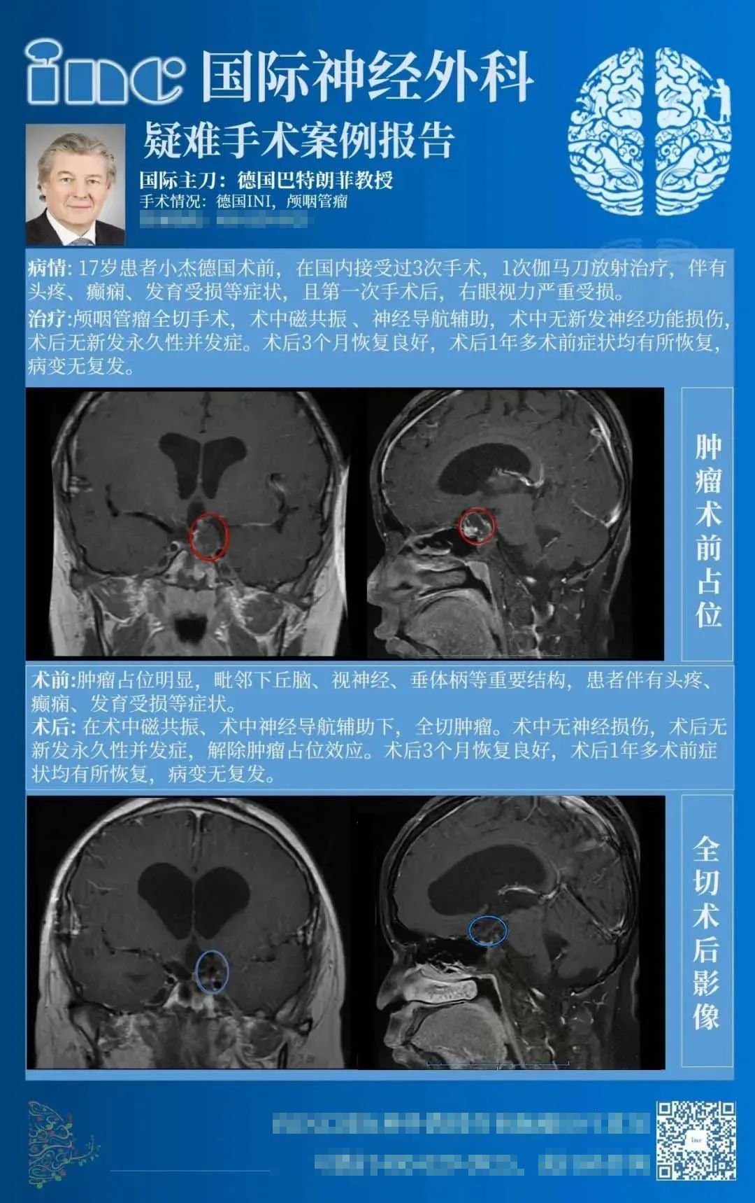 18岁男孩颅咽管瘤16年3次复发，癫痫、发育迟滞