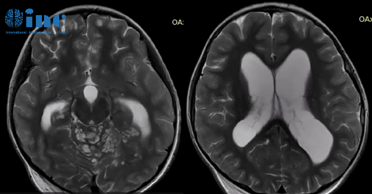 ​8岁男孩罹患罕见脑瘤