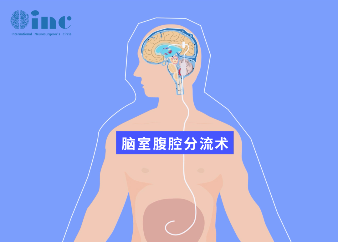 ​8岁男孩罹患少见脑瘤——术后