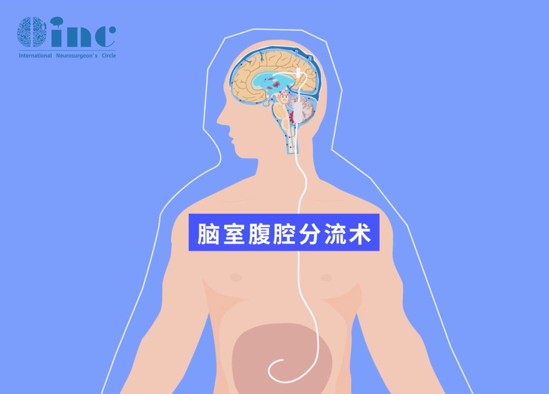 ​8岁男孩罹患罕见脑瘤——术后