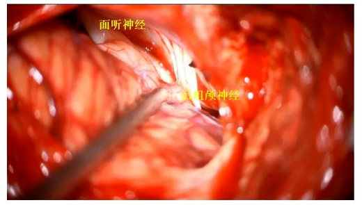 充分显露后组颅神经、面听神经及绒球