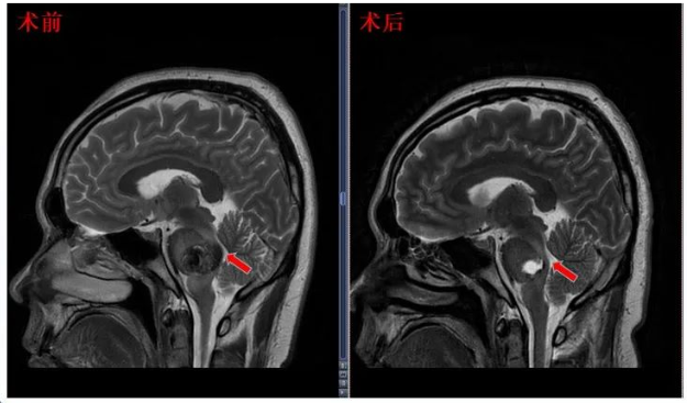 术后患者MRI显示面丘结构恢复