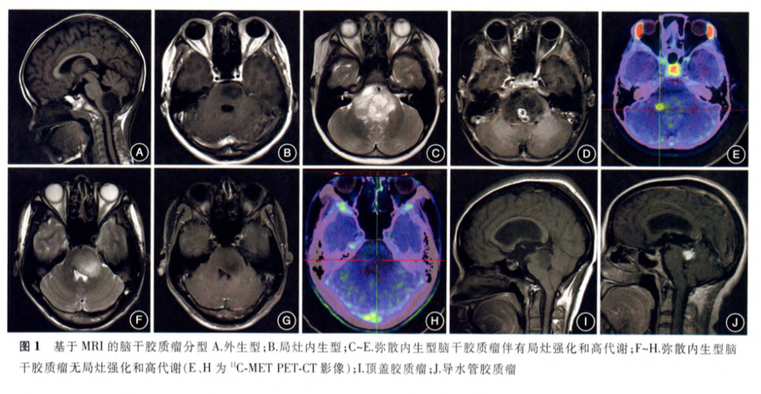 图1.基于MRI的脑干胶质瘤分型A.外生型；B.局灶内生型；C-E.弥散内生型脑干胶质瘤伴有局灶强化和高代谢；F-H.弥散内生型脑干胶质瘤无局灶强化和高代谢（C、H为11C-METPET-CT影像）；I.顶盖胶质瘤；J.导水管胶质瘤.不同型治疗或预后会有差别。图自脑干胶质瘤诊疗共识