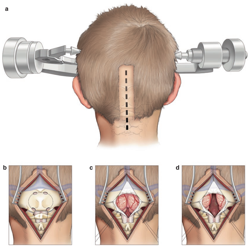 (a)后颅窝病变的标准中线入路，适用于背侧外生型脑干胶质瘤。患者俯卧位固定（上图），进行小的局部中线剃发。(b)枕部中线暴露进行时要记住两侧横窦的定位。如图所示进行开颅手术。四个钻孔用于准备用于去除颅骨的开颅器。小心识别枕骨大孔的唇部，以免在使用开颅器时造成硬脑膜撕裂。(c)硬脑膜以Y形方式切开并反折，其边缘用钉缝线固定。(d)小脑半球被轻轻，暴露第四脑室。显微镜用于切除肿瘤，注意不要在任何时候越过第四脑室底部。或者，可以使用经髓帆入路进行肿瘤切除