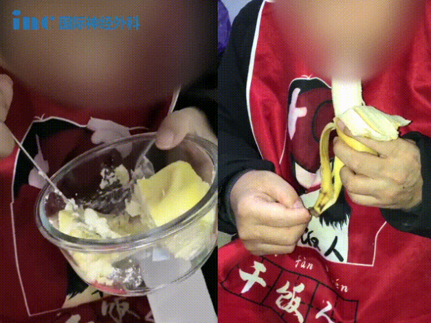 48岁男性较大脊索瘤5年内4次复发3次手术