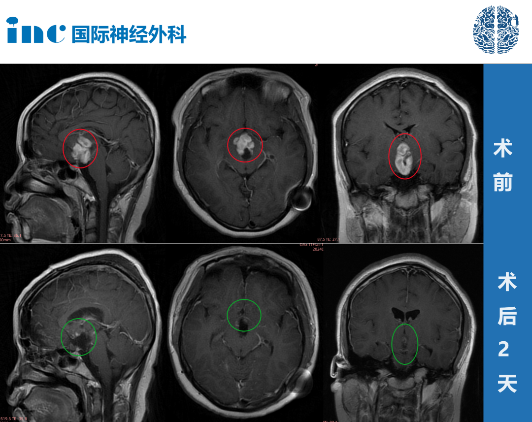 视神经-下丘脑区巨大胶质瘤案例