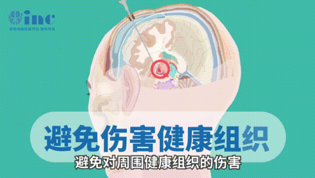 准确定位病灶