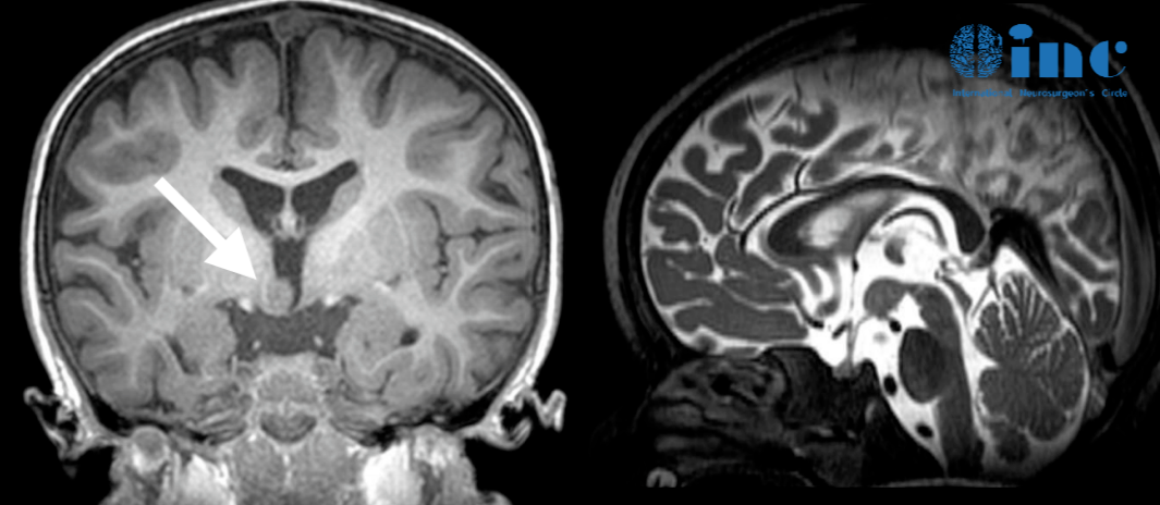 治疗过程：Rutka教授及其团队做了非常充分的准备，激光间质热疗利用的是先进的磁共振成像MRI引导技术，教授团队清晰地识别肿瘤与周围健康脑组织的位置关系，进而制定精确的手术路径。