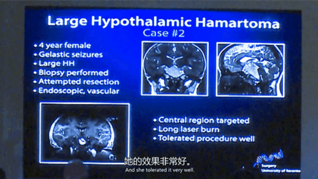 四岁女童深受痴笑样癫痫困扰  　　LITT技术消融元凶下丘脑错构瘤