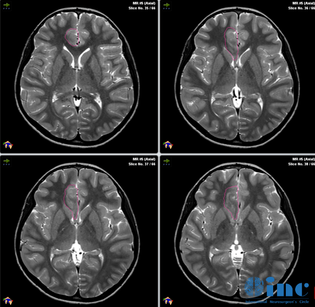 治疗过程：在MRI引导技术，教授团队清晰地识别肿瘤与周围健康脑组织的位置关系，进而制定精确的手术路径，成功消融了Jason脑内残余的病变组织。
