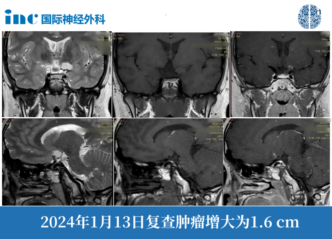 颅咽管瘤复发？需要手术吗？