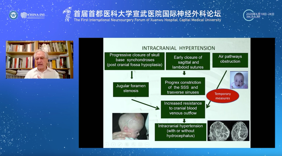 国际儿童颅底学会创始人Di Rocco教授深入解读