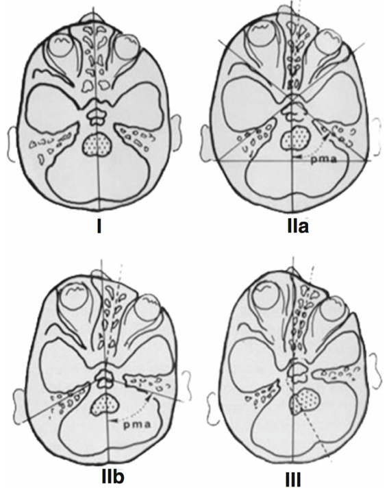 Di Rocco教授提出的前斜头畸形分型方法，其基于面颅骨畸形的不同程度。