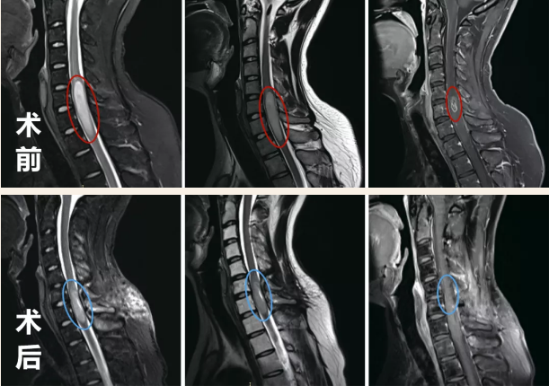 脊髓髓内星形细胞瘤能治好吗?30岁白领成功手术案例分享