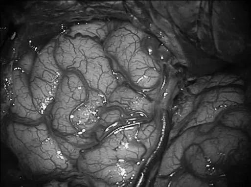 左侧翼点开颅，再次手术，显露前颞叶。