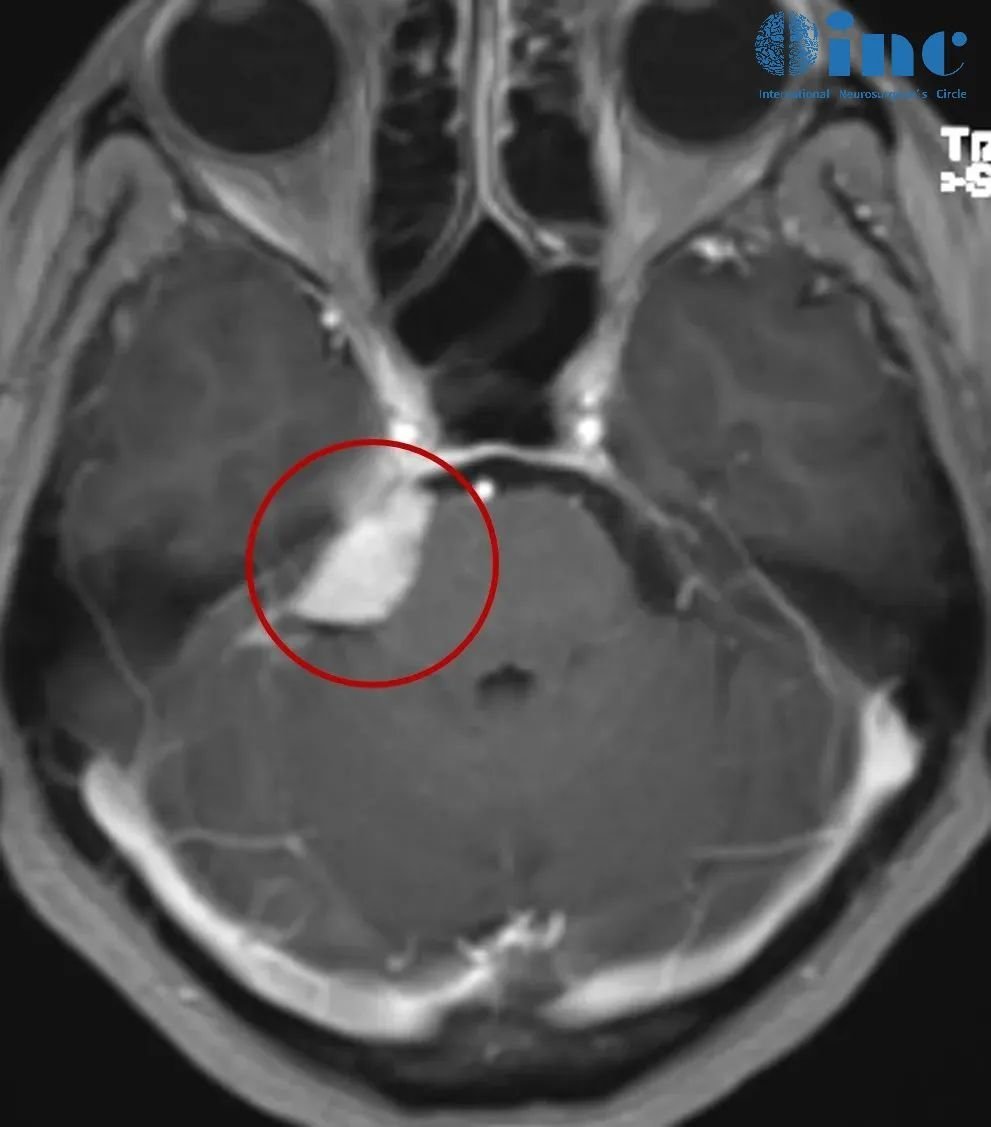 发现脑膜瘤首选伽马刀还是手术？