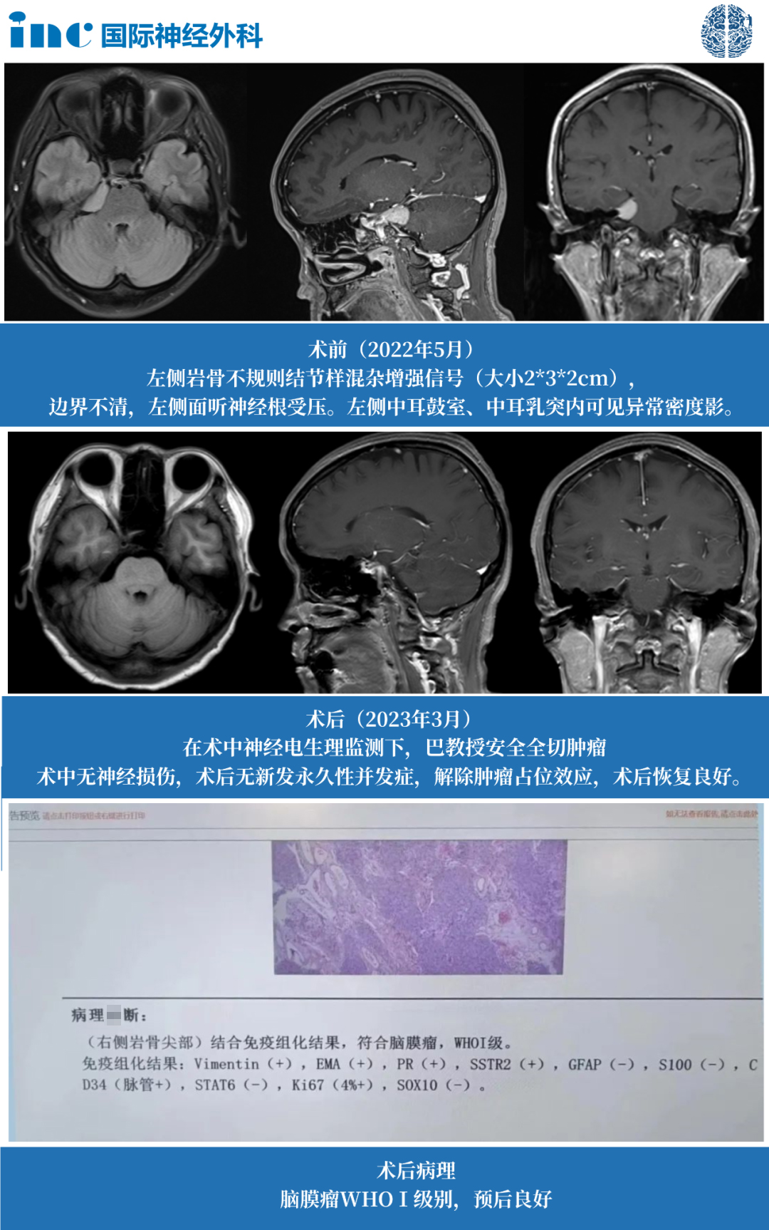 脑膜瘤伽马刀好还是手术好