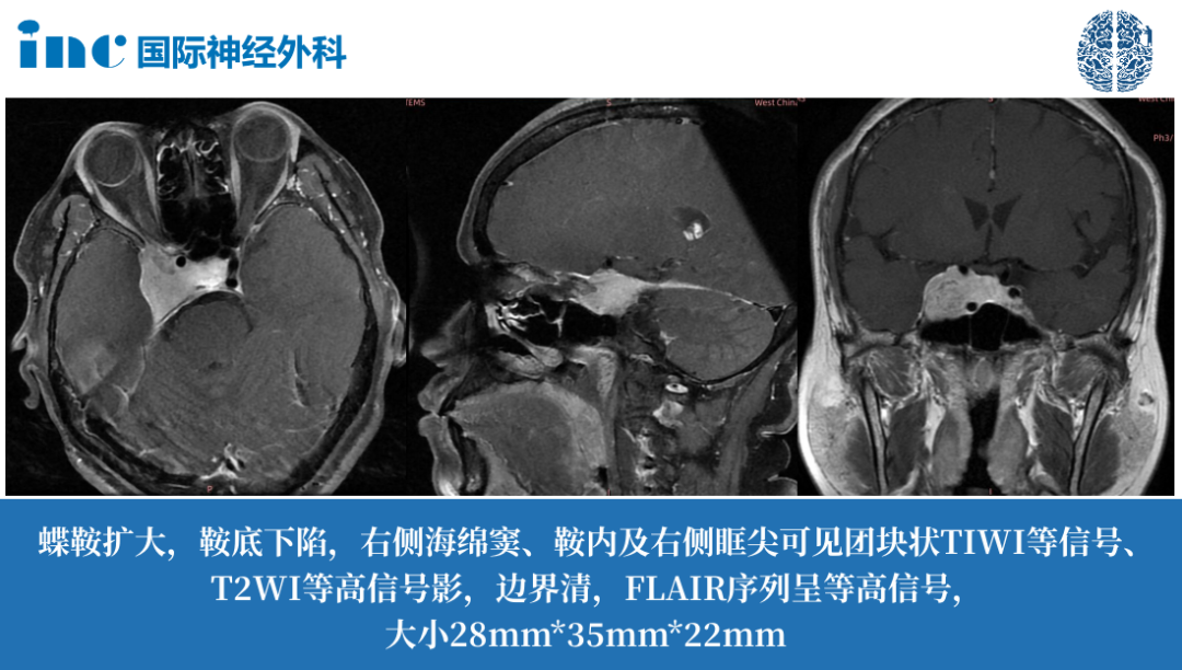48岁女士-右侧海绵窦、鞍内及右侧眶尖脑膜瘤