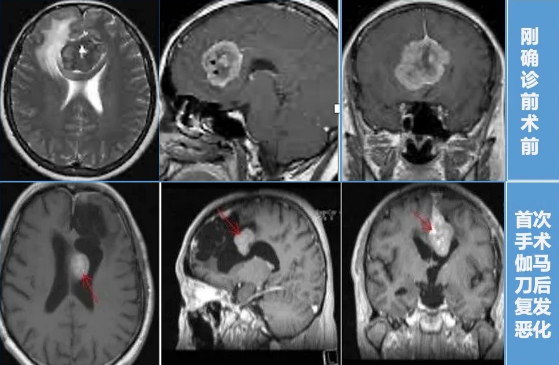 脑膜瘤复发还能手术吗——案例