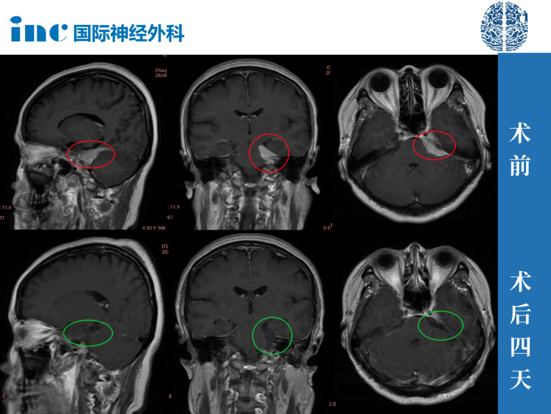 这次手术距离刚查出来脑膜瘤已经有半年多之久，先前的医生均表示：手术风险很大，造成视力、视野缺损等后遗症，而且如果肿瘤切不干净较有可能复发。