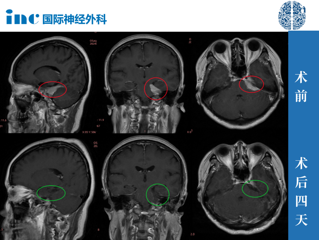 这次手术距离刚查出来脑膜瘤已经有半年多之久，先前的医生均表示：手术风险很大，造成视力、视野缺损等后遗症，而且如果肿瘤切不干净极有可能复发。