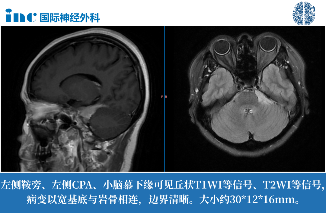 脑膜瘤真的有必要开颅手术吗