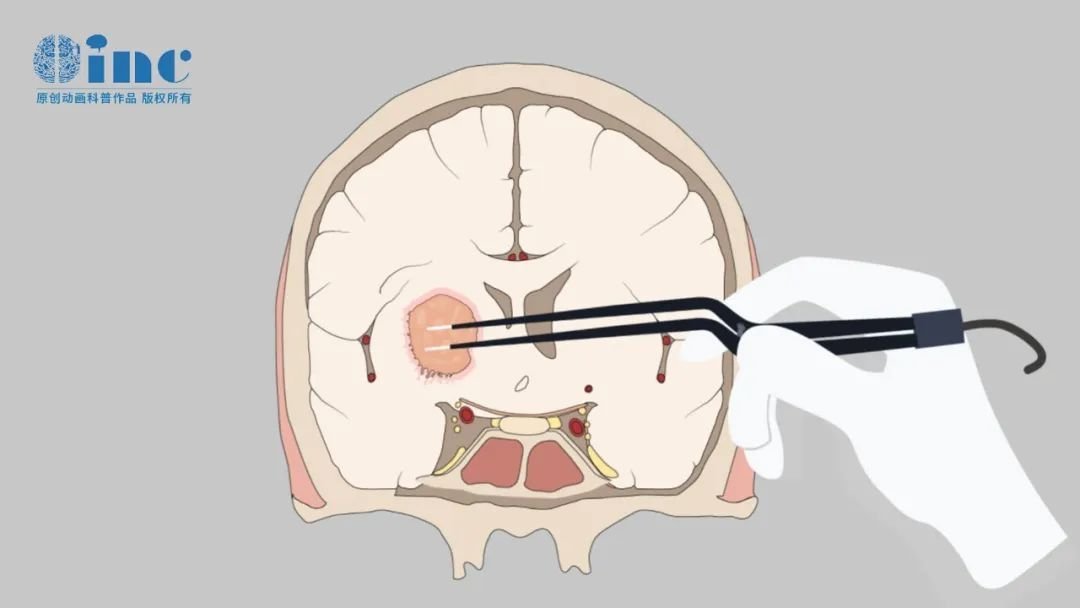 巨大海绵窦肿瘤—世界颅底大咖福洛里希教授如何手术？