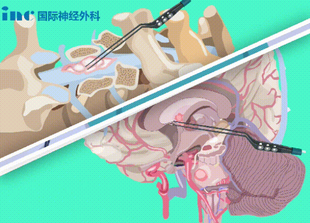 双较电凝是什么？