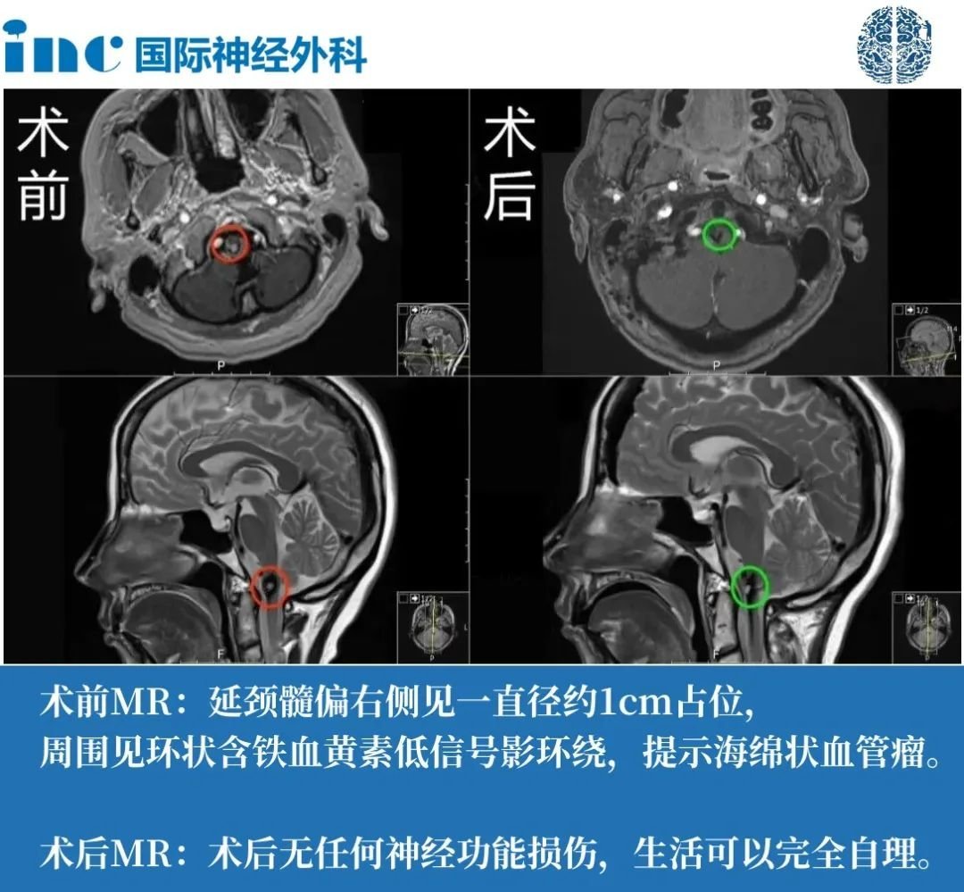 高位颈髓海绵状血管瘤