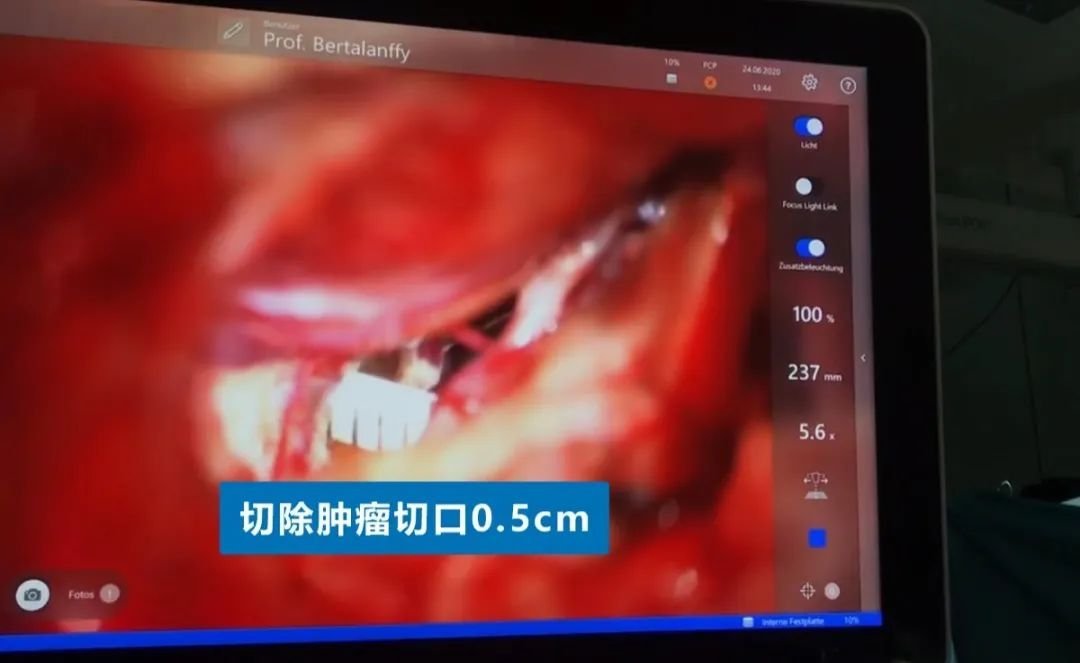 INC德国巴特朗菲教授手术实拍